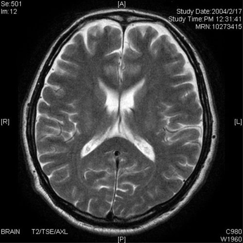 誤解されやすい病気 高次脳機能障害 とは 言語聴覚療法学科ブログ